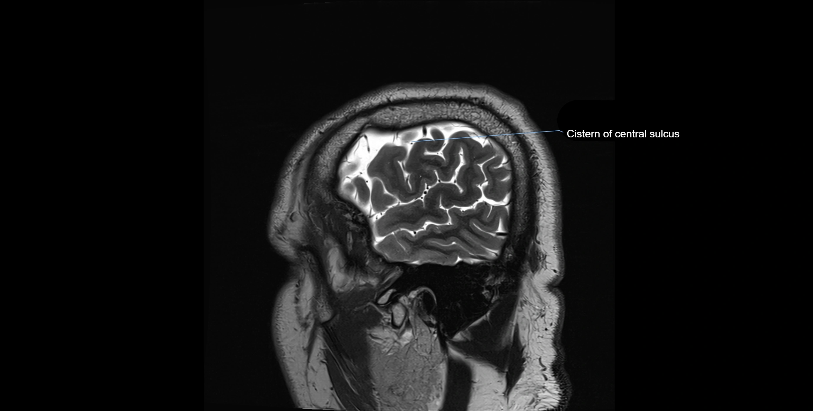 Brain cisterns  and ventricles sagittal anatomy 3T MRI image-img-00001-00003.webp